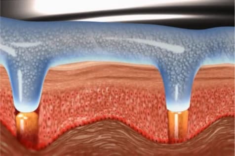 Cross-section showing the preparation reaching the dermis