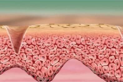 Cross-section of skin after fine dermabrasion